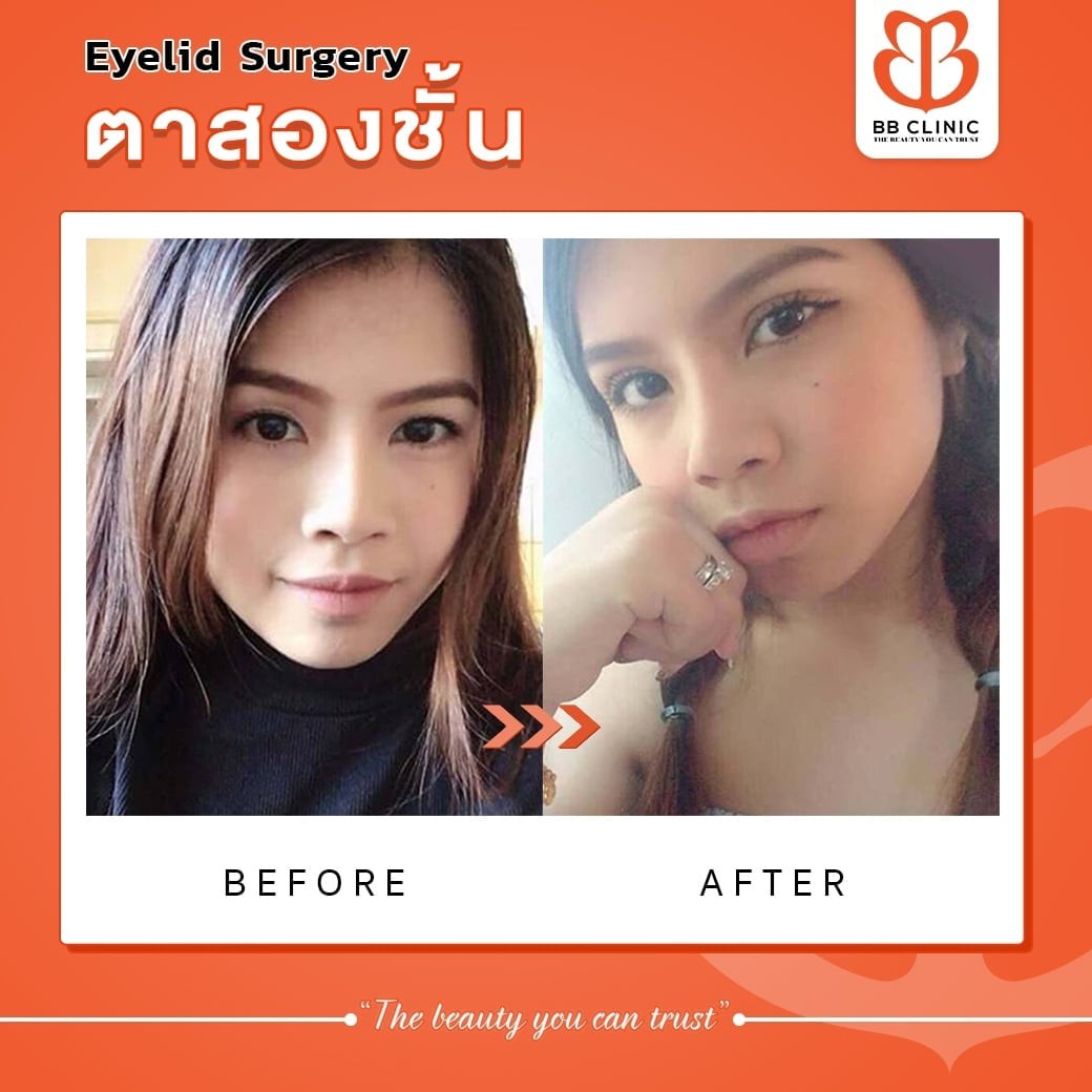 BB Clinic Official - ตาสวยคมชัด แก้ไขปัญหาชั้นตาแคบ ตาไม่เท่ากัน หรือหนังตาตก และอีกทุกปัญหาที่ทำให้คุณไม่มั่นใจ