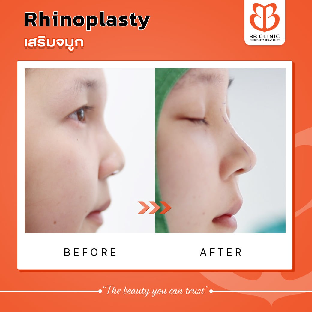 BB Clinic Official - เสริมจมูกเทคนิคเฉพาะ BB Clinic รูปทรงเข้ากับใบหน้า เพิ่มโหงวเฮ้งให้ปัง ‍️